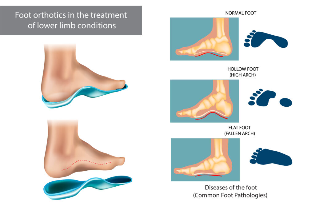 Foot orthotics