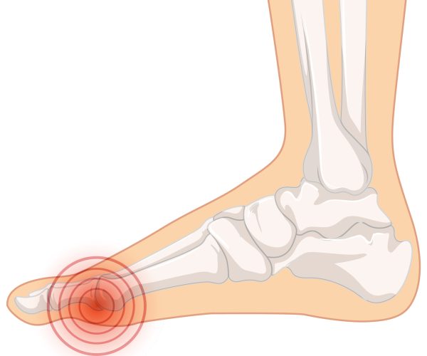 Hallux valgus types on white background illustration